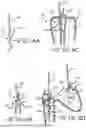 Fig. 08 - LOADING APPARATUS AND SYSTEM FOR EXPANDABLE INTRALUMINAL MEDICAL DEVICES
