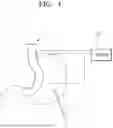 Fig. 02 - SLEEVE GASTRECTOMY AID DEVICE