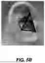 Fig. 07 - EAR INSERT SHAPE DETERMINATION