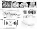 Fig. 02 - SYSTEM TO IDENTIFY TRANSITIONS IN BRAIN STATES FROM ELECTROPHYSIOLOGICAL MARKERS IN DBS FOR DEPRESSION
