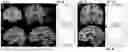 Fig. 06 - SYSTEM TO IDENTIFY TRANSITIONS IN BRAIN STATES FROM ELECTROPHYSIOLOGICAL MARKERS IN DBS FOR DEPRESSION