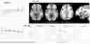 Fig. 09 - SYSTEM TO IDENTIFY TRANSITIONS IN BRAIN STATES FROM ELECTROPHYSIOLOGICAL MARKERS IN DBS FOR DEPRESSION