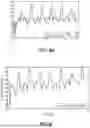 Fig. 05 - Methods and systems for controlling blood pressure by controlling atrial pressure