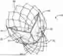 Fig. 01 - DEVICES AND METHODS FOR AORTIC VALVE PREPARATION PRIOR TO TRANSCATHETER PROSTHETIC VALVE PROCEDURES