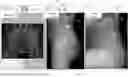 Fig. 01 - System and method for preoperative planning for total hip arthroplasty