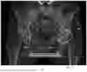 Fig. 03 - System and method for preoperative planning for total hip arthroplasty