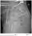 Fig. 04 - System and method for preoperative planning for total hip arthroplasty