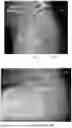 Fig. 05 - System and method for preoperative planning for total hip arthroplasty