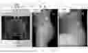 Fig. 06 - System and method for preoperative planning for total hip arthroplasty