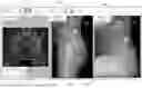 Fig. 07 - System and method for preoperative planning for total hip arthroplasty