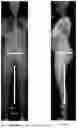 Fig. 11 - System and method for preoperative planning for total hip arthroplasty