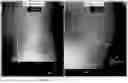 Fig. 12 - System and method for preoperative planning for total hip arthroplasty