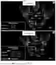 Fig. 13 - System and method for preoperative planning for total hip arthroplasty