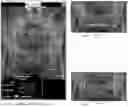 Fig. 15 - System and method for preoperative planning for total hip arthroplasty