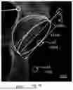 Fig. 18 - System and method for preoperative planning for total hip arthroplasty