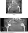Fig. 26 - System and method for preoperative planning for total hip arthroplasty