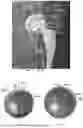 Fig. 28 - System and method for preoperative planning for total hip arthroplasty