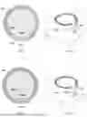 Fig. 08 - LASIK FLAP CUTTING PATTERNS INCLUDING INTRASTROMAL POCKET FOR BUBBLE MANAGEMENT