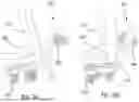 Fig. 04 - CERVICAL LAMINOPLASTY INSTRUMENTS AND PROCEDURES