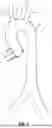 Fig. 02 - LOW PROFILE EMBOLIC PROTECTION DEVICE AND SYSTEM