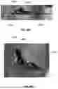 Fig. 43 - Devices, systems, and methods for manipulating nasal tissues
