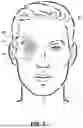 Fig. 06 - EYE SHIELD STRIP-AID METHOD AND DEVICES