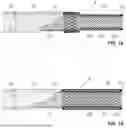 Fig. 02 - CATHETER APPARATUS AND METHODS FOR ENDOLUMINAL INTERVENTION
