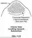 Fig. 131 - PIXEL ARRAY MEDICAL SYSTEMS, DEVICES AND METHODS