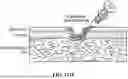 Fig. 265 - PIXEL ARRAY MEDICAL SYSTEMS, DEVICES AND METHODS