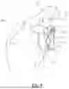 Fig. 07 - SCAPULAR ANCHOR FOR FIXING A GLENOID COMPONENT OF A SHOULDER JOINT PROSTHESIS TO A SCAPULA WITH COMPROMISED ANATOMY