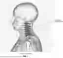 Fig. 02 - METHOD AND APPARATUS FOR SPINAL FACET FUSION