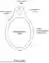 Fig. 46 - Intravascular lithotripsy