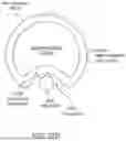 Fig. 48 - Intravascular lithotripsy