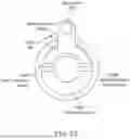 Fig. 52 - Intravascular lithotripsy