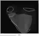Fig. 02 - TRACKING SEGMENTAL MOVEMENT OF THE HEART USING TENSORS