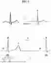 Fig. 02 - METHOD AND APPARATUS FOR CORRECTING ELECTROCARDIOGRAM READING
