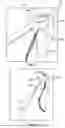 Fig. 06 - KNEE JOINT CAPSULAR DISRUPTION AND REPAIR