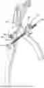 Fig. 01 - Adjustable angle orthopedic distractor, compressor, and distractor-compressor