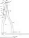 Fig. 22 - Adjustable angle orthopedic distractor, compressor, and distractor-compressor