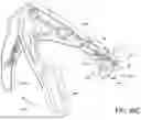 Fig. 72 - PROSTHETIC SUTURING DEVICE AND METHODS THEREOF