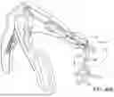 Fig. 76 - PROSTHETIC SUTURING DEVICE AND METHODS THEREOF