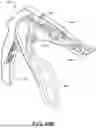 Fig. 83 - PROSTHETIC SUTURING DEVICE AND METHODS THEREOF