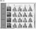 Fig. 22 - COMPOSITION FOR TREATING OF FACIAL DYSMORPHISM IN MUCOPOLYSACCHARIDOSIS