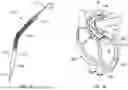 Fig. 02 - PORTABLE VENTRICULAR ASSIST SYSTEM WITH A MULTI-CHANNEL OPTICAL PRESSURE SENSOR