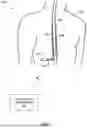 Fig. 02 - MANAGING TRANSIENT OVERSTIMULATION BASED ON ECAPs