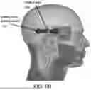 Fig. 07 - EARPIECE ASSEMBLY TO INTERACT WITH IMPLANTABLE NEURAL STIMULATORS
