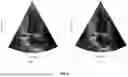 Fig. 07 - SUPER RESOLUTION FOR ELECTRONIC 4D (E4D) CARDIOVASCULAR ULTRASOUND (CVUS) PROBES