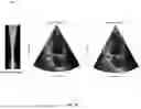 Fig. 10 - SUPER RESOLUTION FOR ELECTRONIC 4D (E4D) CARDIOVASCULAR ULTRASOUND (CVUS) PROBES