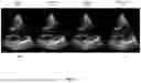 Fig. 15 - SUPER RESOLUTION FOR ELECTRONIC 4D (E4D) CARDIOVASCULAR ULTRASOUND (CVUS) PROBES