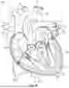 Fig. 02 - TRANSCATHETER VALVE LEAD AND VALVE ELEMENT